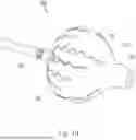 Fig. 11 - DEPLOYABLE STRUCTURES TO PROVIDE ELECTRODES ON THE SURFACE OF AN ENDOSCOPICALLY GUIDED LASER ABLATION CATHETER FOR USE IN ABLATION AND ELECTROPHYSIOLOGICAL MAPPING