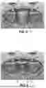 Fig. 04 - JOINT IMPLANTS HAVING POROUS STRUCTURES FORMED UTILIZING ADDITIVE MANUFACTURING AND RELATED SYSTEMS AND METHODS