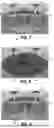 Fig. 06 - JOINT IMPLANTS HAVING POROUS STRUCTURES FORMED UTILIZING ADDITIVE MANUFACTURING AND RELATED SYSTEMS AND METHODS