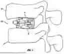Fig. 02 - EXPANDABLE FUSION DEVICE AND METHOD OF INSTALLATION THEREOF