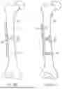 Fig. 23 - METHODS AND DEVICES FOR INTRACORPOREAL BONDING OF IMPLANTS WITH THERMAL ENERGY