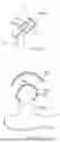 Fig. 83 - METHODS AND DEVICES FOR INTRACORPOREAL BONDING OF IMPLANTS WITH THERMAL ENERGY