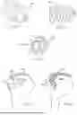 Fig. 85 - METHODS AND DEVICES FOR INTRACORPOREAL BONDING OF IMPLANTS WITH THERMAL ENERGY