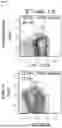 Fig. 02 - CD19-SPECIFIC CHIMERIC ANTIGEN RECEPTOR T-CELL THERAPY