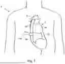 Fig. 02 - BLOOD CLOT REMOVAL DEVICE, SYSTEM, AND METHOD