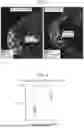 Fig. 04 - Methods of Treating Lymphoma with a Phagocyte Having a Chimeric Antigen Receptor