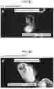 Fig. 07 - Methods of Treating Lymphoma with a Phagocyte Having a Chimeric Antigen Receptor
