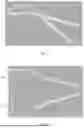 Fig. 03 - MOUNTING DEVICE OF CARDIAC NET AND METHOD OF MOUNTING CARDIAC NET