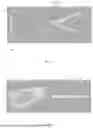 Fig. 04 - MOUNTING DEVICE OF CARDIAC NET AND METHOD OF MOUNTING CARDIAC NET