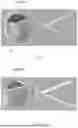 Fig. 10 - MOUNTING DEVICE OF CARDIAC NET AND METHOD OF MOUNTING CARDIAC NET