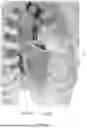 Fig. 14 - MOUNTING DEVICE OF CARDIAC NET AND METHOD OF MOUNTING CARDIAC NET
