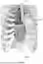 Fig. 15 - MOUNTING DEVICE OF CARDIAC NET AND METHOD OF MOUNTING CARDIAC NET