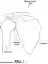 Fig. 02 - GLENOID IMPLANT COMPONENTS AND INSTRUMENTS THEREFOR