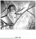 Fig. 16 - Wearable Auricular Neurostimulator and Methods of Use