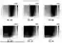 Fig. 45 - PRESBYOPIA-CORRECTING LENS SYSTEM HAVING HYPEROPIC / MYOPIC CORRECTION-DEPENDENT DESIGNS