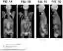Fig. 02 - TREATMENT OF B CELL MALIGNANCIES