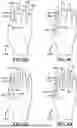 Fig. 11 - GLOVE WITH LONGITUDINAL STAYS
