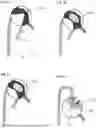 Fig. 08 - DEVICE AND METHOD FOR ABLATIVE TREATMENT OF TARGETED AREAS WITHIN A BODY LUMEN
