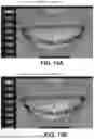 Fig. 19 - COMPUTER IMPLEMENTED METHODS FOR DENTAL DESIGN