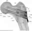 Fig. 01 - Recon Hip Screw