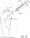 Fig. 02 - SYSTEM AND METHODS FOR SOFT-TISSUE AUGMENTATION