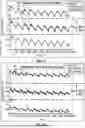 Fig. 06 - ADJUSTMENT OF AN INFUSION PUMP BASED ON PRESSURE CHANGES IN AN INFUSION LINE