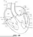 Fig. 02 - DIAGNOSTIC CATHETERS, GUIDE CATHETERS, VISUALIZATION DEVICES AND CHORD MANIPULATION DEVICES, AND RELATED KITS AND METHODS