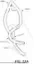 Fig. 45 - DIAGNOSTIC CATHETERS, GUIDE CATHETERS, VISUALIZATION DEVICES AND CHORD MANIPULATION DEVICES, AND RELATED KITS AND METHODS