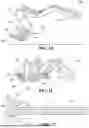 Fig. 06 - SHUNT SYSTEM FOR DRAINING EXCESS CEREBROSPINAL FLUID