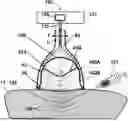 Fig. 01 - PRESSURE WAVE SYRINGE DEVICE
