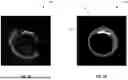 Fig. 05 - THREE-DIMENSIONAL VESSEL CONSTRUCTION FROM INTRAVASCULAR ULTRASOUND IMAGES