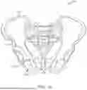 Fig. 02 - SHAPE ADAPTABLE INTRAMEDULLARY FIXATION DEVICE