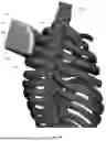 Fig. 131 - Device for Releasing Spinal Contractures and Associated Methods