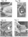 Fig. 02 - MALLEABLE BONE REPAIR MATERIAL