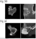 Fig. 06 - MALLEABLE BONE REPAIR MATERIAL