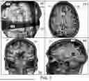 Fig. 04 - AUTOMATIC NEUROSURGICAL TARGET AND ENTRY POINT IDENTIFICATION