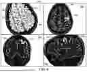 Fig. 05 - AUTOMATIC NEUROSURGICAL TARGET AND ENTRY POINT IDENTIFICATION