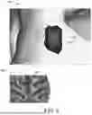 Fig. 06 - AUTOMATIC NEUROSURGICAL TARGET AND ENTRY POINT IDENTIFICATION