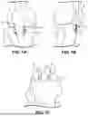 Fig. 02 - MULTIPLANAR TENDON REALIGNMENT IMPLANTS AND RELATED SYSTEMS AND METHODS