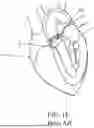 Fig. 04 - HEART VALVE THAT INCLUDES COATING MATERIAL