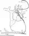 Fig. 01 - TRANSVENOUS PHRENIC NERVE STIMULATION SYSTEM