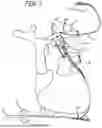 Fig. 02 - TRANSVENOUS PHRENIC NERVE STIMULATION SYSTEM