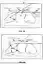 Fig. 13 - TWO-STEP BEAM GEOMETRY OPTIMIZATION AND BEAM ENTRY ANGLES WITHOUT ISOCENTER