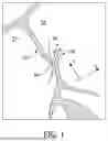 Fig. 02 - METHODS AND DEVICE FOR CLOSURE OF A TISSUE DEFECT