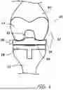 Fig. 02 - System and Method for Creating Customized Spacers for Use in Knee Arthroplasty