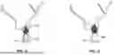 Fig. 09 - DEVICES AND METHODS FOR TRANSVASCULAR DRAINAGE OF FLUIDS IN AN INTRACRANIAL EXTRAVASCULAR SPACE
