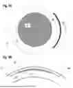Fig. 07 - CORRECTING THE REFRACTION OF AN EYE BY CORNEAL MODIFICATION