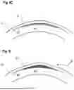 Fig. 08 - CORRECTING THE REFRACTION OF AN EYE BY CORNEAL MODIFICATION
