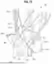 Fig. 08 - PROSTHETIC VALVE