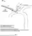Fig. 02 - IMPROVED CEREBRAL ANGIOGRAPHY CATHETER